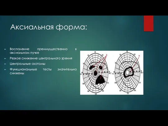 Аксиальная форма: Воспаление преимущественно в аксиальном пучке Резкое снижение центрального зрения