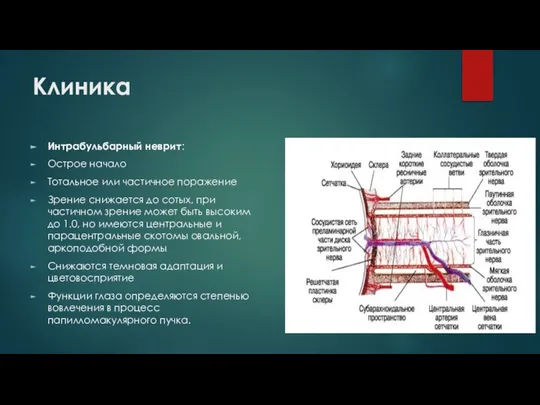 Клиника Интрабульбарный неврит: Острое начало Тотальное или частичное поражение Зрение снижается