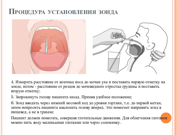 Процедура установления зонда 4. Измерить расстояние от кончика носа до мочки