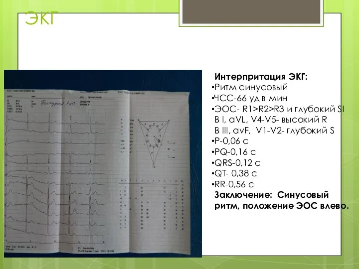 ЭКГ Интерпритация ЭКГ: Ритм синусовый ЧСС-66 уд в мин ЭОС- R1>R2>R3