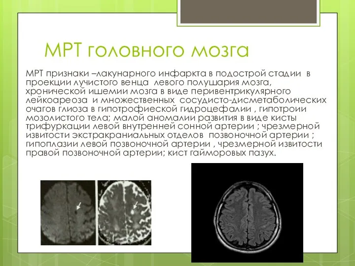 МРТ головного мозга МРТ признаки –лакунарного инфаркта в подострой стадии в