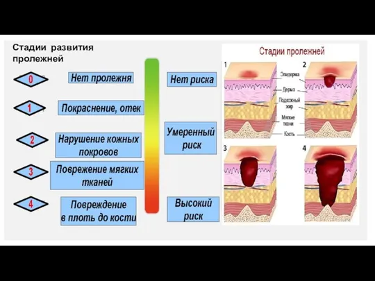 Стадии развития пролежней