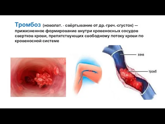 Тромбоз (новолат. - свёртывание от др.-греч.-сгусток) — прижизненное формирование внутри кровеносных