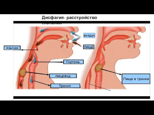 Дисфагия- расстройство глотания