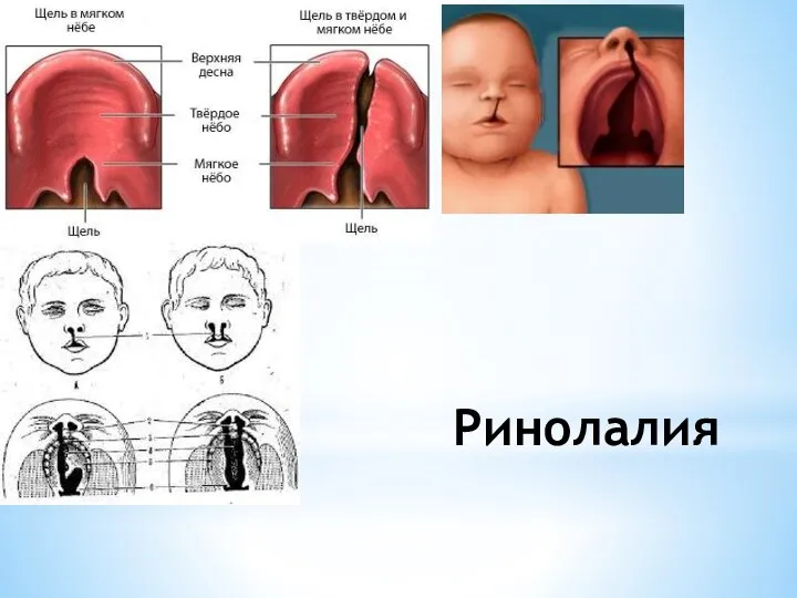 Ринолалия