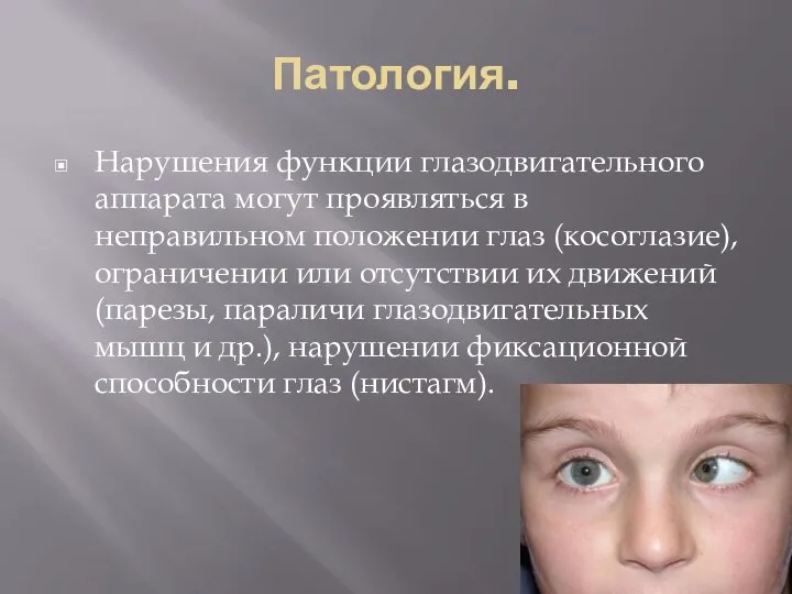 Патология. Нарушения функции глазодвигательного аппарата могут проявляться в неправильном положении глаз