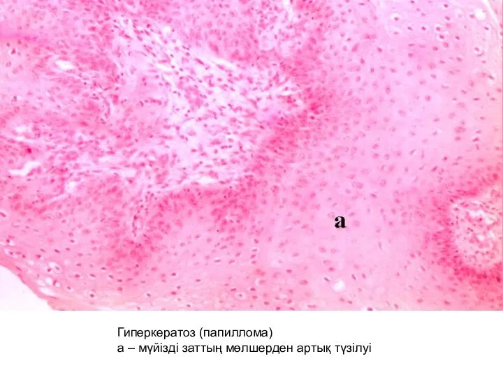 Гиперкератоз (папиллома) а – мүйізді заттың мөлшерден артық түзілуі