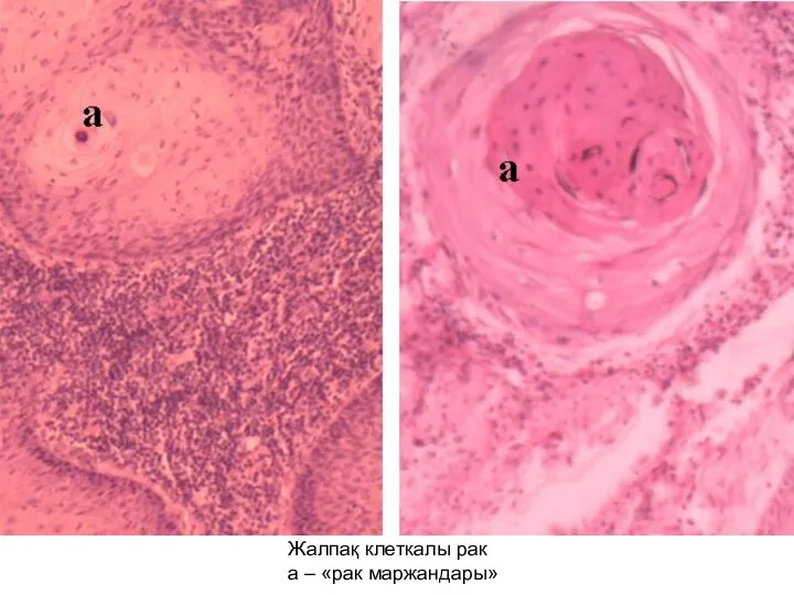 Жалпақ клеткалы рак а – «рак маржандары»