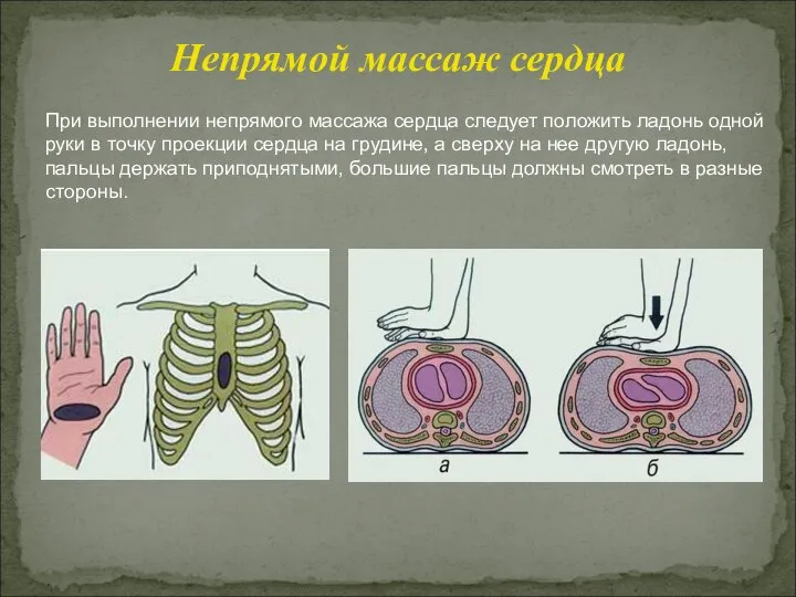 При выполнении непрямого массажа сердца следует положить ладонь одной руки в