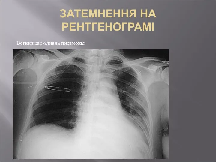 ЗАТЕМНЕННЯ НА РЕНТГЕНОГРАМІ Вогнищево-зливна пневмонія