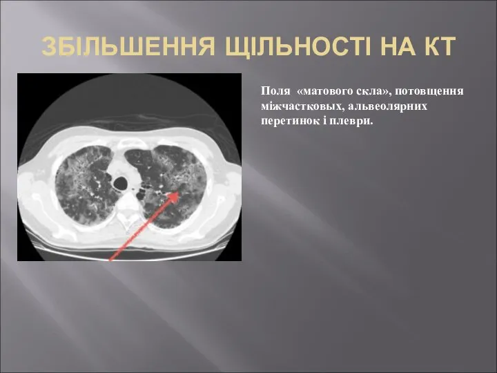 ЗБІЛЬШЕННЯ ЩІЛЬНОСТІ НА КТ Поля «матового скла», потовщення міжчастковых, альвеолярних перетинок і плеври.