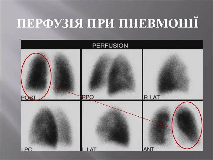 ПЕРФУЗІЯ ПРИ ПНЕВМОНІЇ