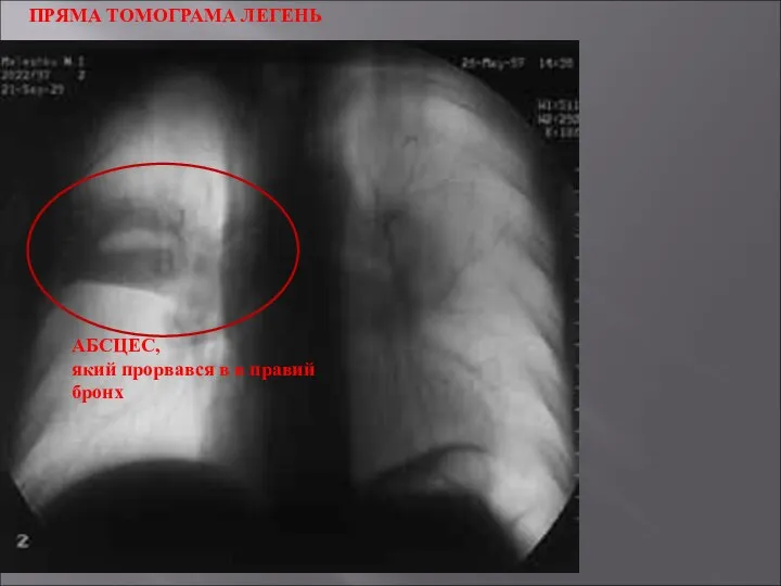 ПРЯМА ТОМОГРАМА ЛЕГЕНЬ АБСЦЕС, який прорвався в в правий бронх