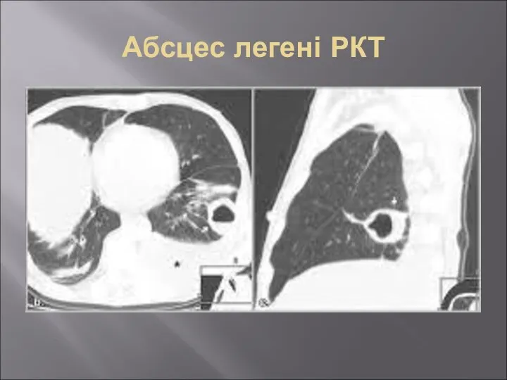 Абсцес легені РКТ