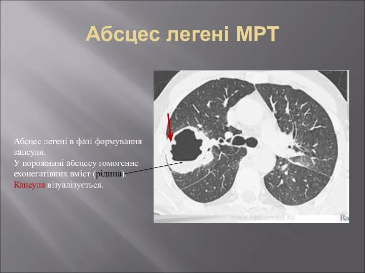 Абсцес легені МРТ Абсцес легені в фазі формування капсули. У порожнині