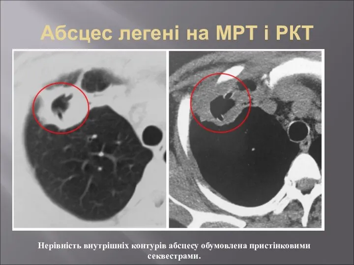 Абсцес легені на МРТ і РКТ Нерівність внутрішніх контурів абсцесу обумовлена пристінковими секвестрами.