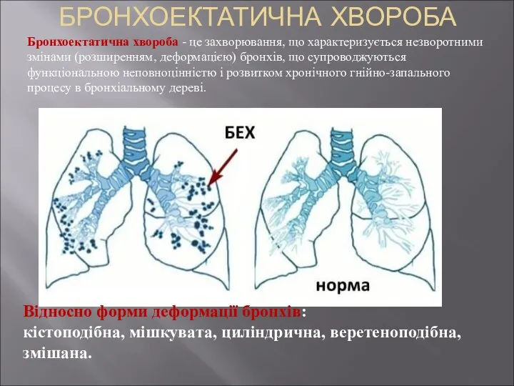 БРОНХОЕКТАТИЧНА ХВОРОБА Відносно форми деформації бронхів: кістоподібна, мішкувата, циліндрична, веретеноподібна, змішана.