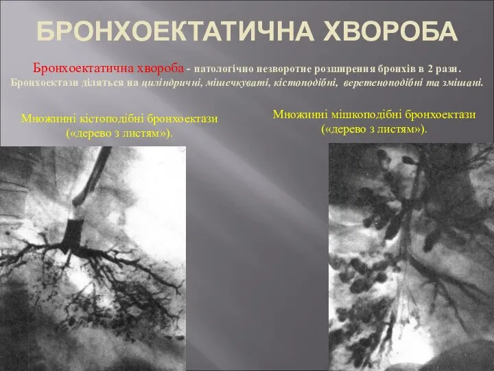 Бронхоектатична хвороба - патологічно незворотне розширення бронхів в 2 рази. Бронхоектази