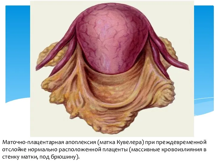 Маточно-плацентарная апоплексия (матка Кувелера) при преждевременной отслойке нормально расположенной плаценты (массивные