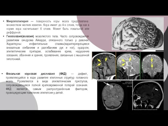 Фокальная корковая дисплазия (ФКД) — дефект, проявляющийся в ходе развития клеточных