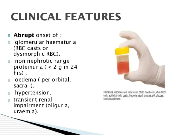 Abrupt onset of : glomerular haematuria (RBC casts or dysmorphic RBC).