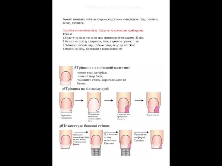 Ремонт зламаних нігтів виконуємо жорсткими матеріалами-гель, полігель, акрил, акригель. Потрібна зчіпка-м'яка