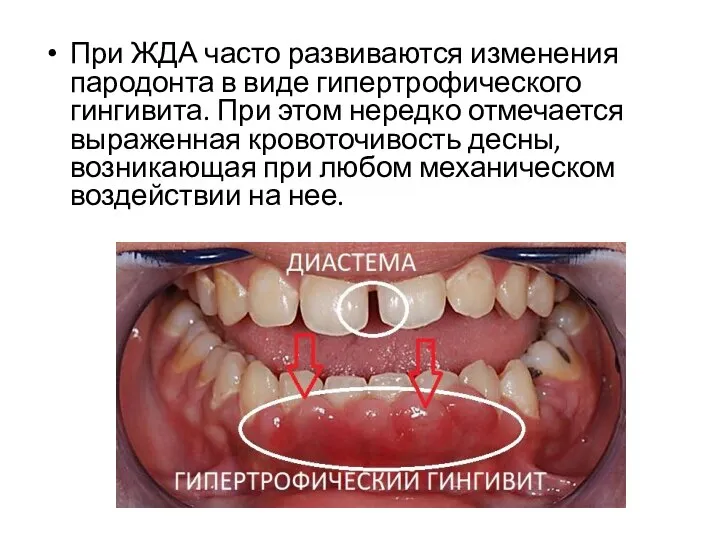 При ЖДА часто развиваются изменения пародонта в виде гипертрофического гингивита. При