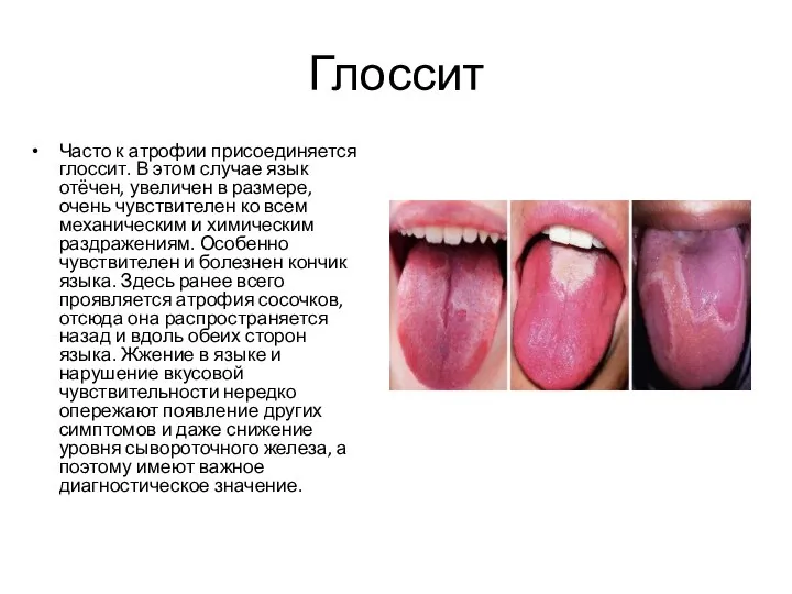 Глоссит Часто к атрофии присоединяется глоссит. В этом случае язык отёчен,