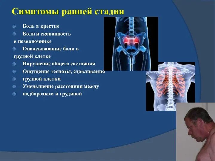 Симптомы ранней стадии Боль в крестце Боли и скованность в позвоночнике