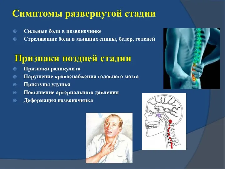 Симптомы развернутой стадии Сильные боли в позвоночнике Стреляющие боли в мышцах