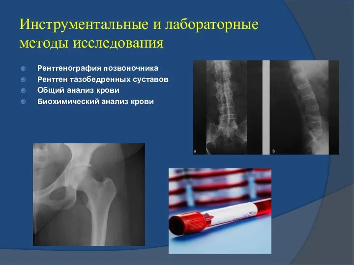 Инструментальные и лабораторные методы исследования Рентгенография позвоночника Рентген тазобедренных суставов Общий анализ крови Биохимический анализ крови