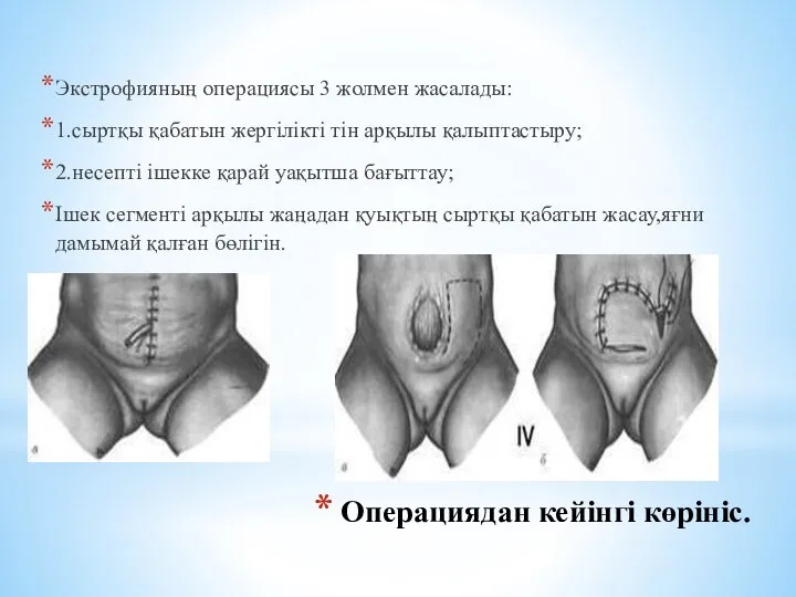 Экстрофияның операциясы 3 жолмен жасалады: 1.сыртқы қабатын жергілікті тін арқылы қалыптастыру;