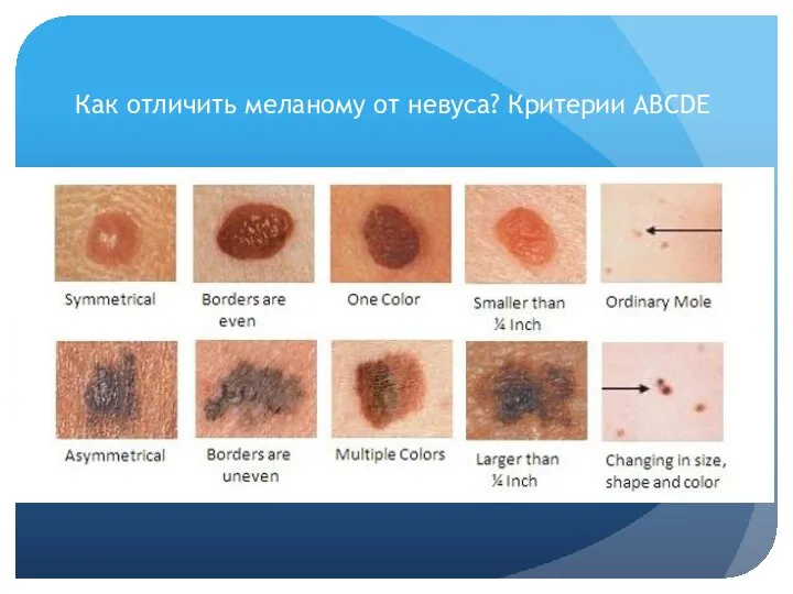 Как отличить меланому от невуса? Критерии ABCDE