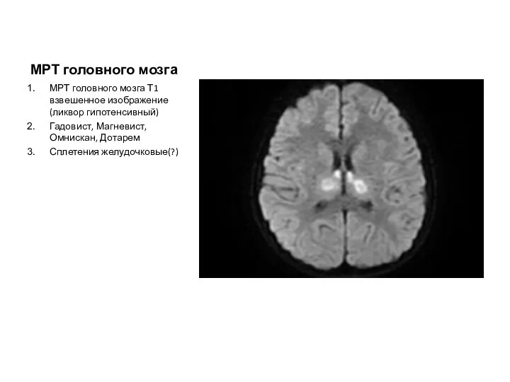 МРТ головного мозга МРТ головного мозга Т1 взвешенное изображение(ликвор гипотенсивный) Гадовист, Магневист, Омнискан, Дотарем Сплетения желудочковые(?)
