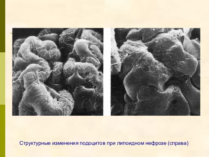 Структурные изменения подоцитов при липоидном нефрозе (справа)