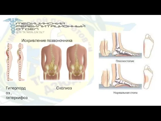 Искривление позвоночника Гиперлордоз ,гиперкифоз Сколиоз