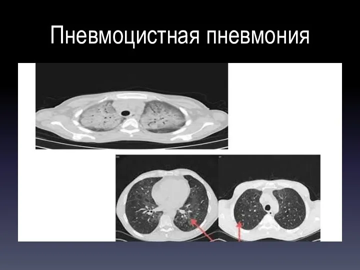 Пневмоцистная пневмония