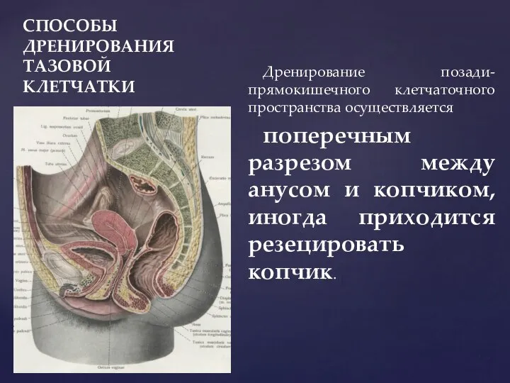 СПОСОБЫ ДРЕНИРОВАНИЯ ТАЗОВОЙ КЛЕТЧАТКИ Дренирование позади-прямокишечного клетчаточного пространства осуществляется поперечным разрезом