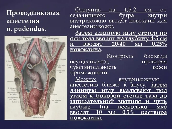 Проводниковая анестезия n. pudendus. Отступив на 1,5-2 см от седалищного бугра