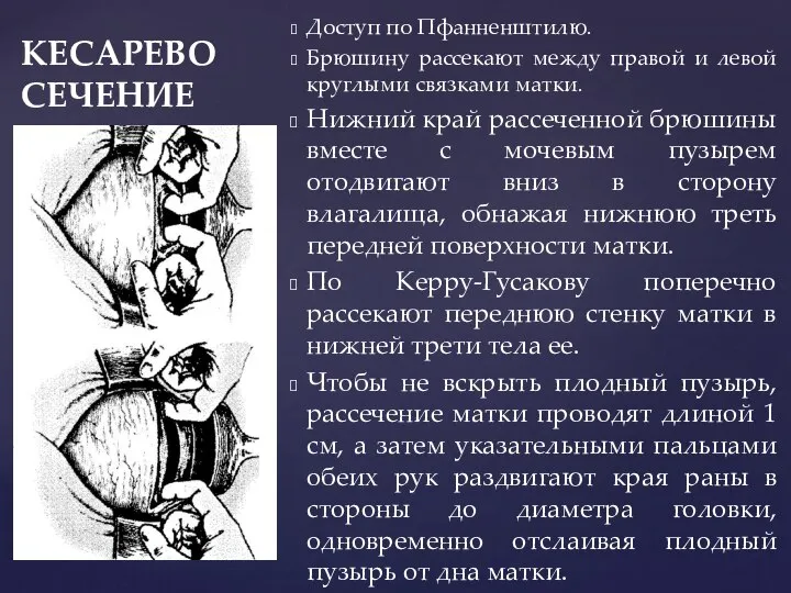 КЕСАРЕВО СЕЧЕНИЕ Доступ по Пфанненштилю. Брюшину рассекают между правой и левой