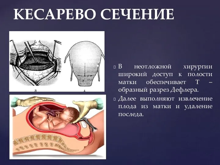 КЕСАРЕВО СЕЧЕНИЕ В неотложной хирургии широкий доступ к полости матки обеспечивает