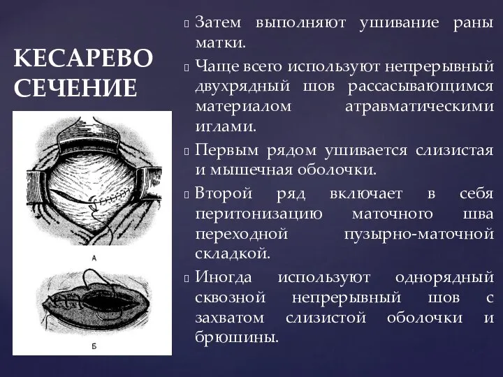 КЕСАРЕВО СЕЧЕНИЕ Затем выполняют ушивание раны матки. Чаще всего используют непрерывный