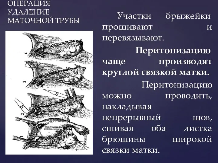 ОПЕРАЦИЯ УДАЛЕНИЕ МАТОЧНОЙ ТРУБЫ Участки брыжейки прошивают и перевязывают. Перитонизацию чаще