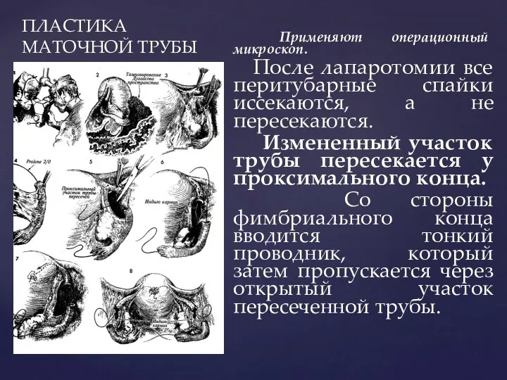 ПЛАСТИКА МАТОЧНОЙ ТРУБЫ Применяют операционный микроскоп. После лапаротомии все перитубарные спайки