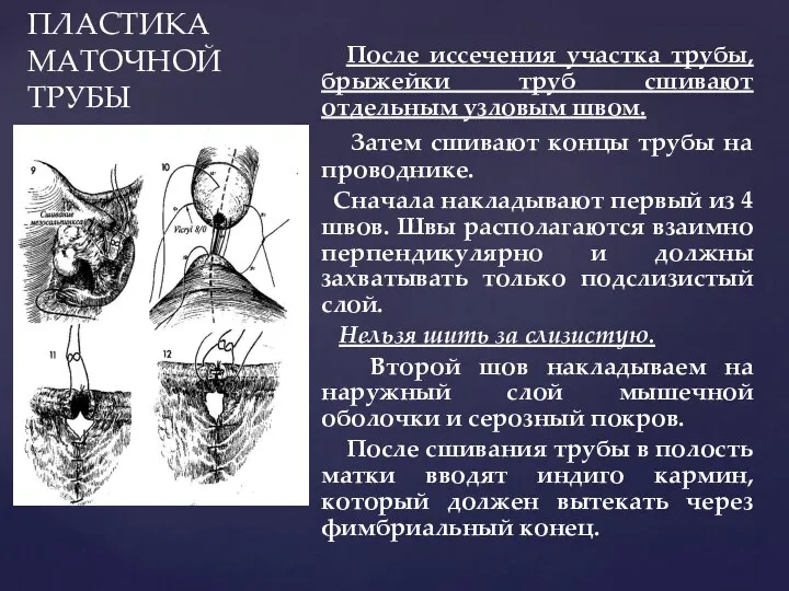 ПЛАСТИКА МАТОЧНОЙ ТРУБЫ После иссечения участка трубы, брыжейки труб сшивают отдельным