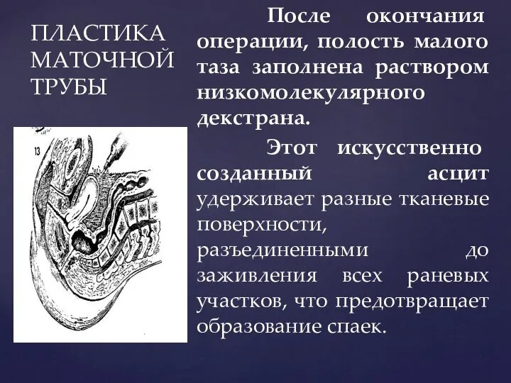 ПЛАСТИКА МАТОЧНОЙ ТРУБЫ После окончания операции, полость малого таза заполнена раствором