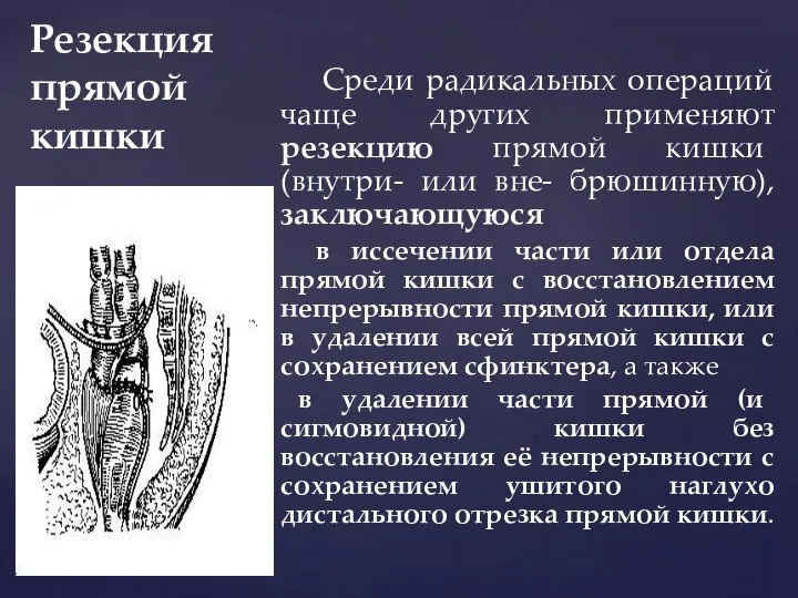 Резекция прямой кишки Среди радикальных операций чаще других применяют резекцию прямой