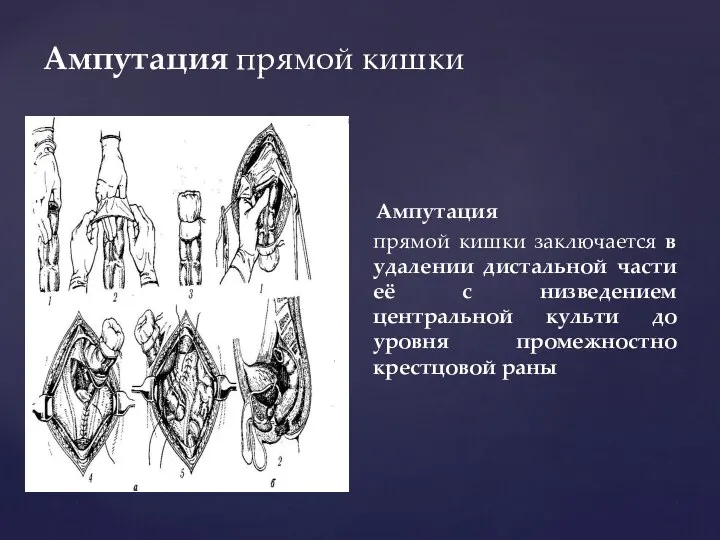 Ампутация прямой кишки Ампутация прямой кишки заключается в удалении дистальной части