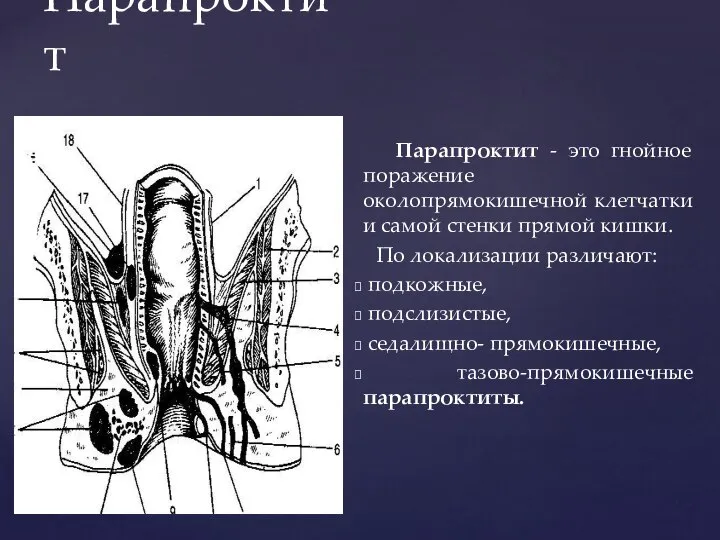 Парапроктит Парапроктит - это гнойное поражение околопрямокишечной клетчатки и самой стенки