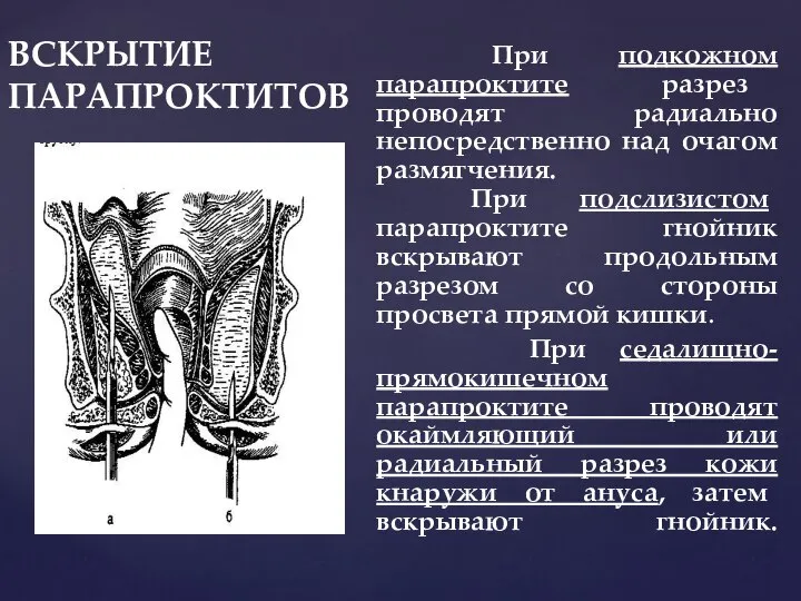 ВСКРЫТИЕ ПАРАПРОКТИТОВ При подкожном парапроктите разрез проводят радиально непосредственно над очагом